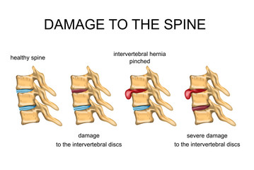 colonna vertebrale danno